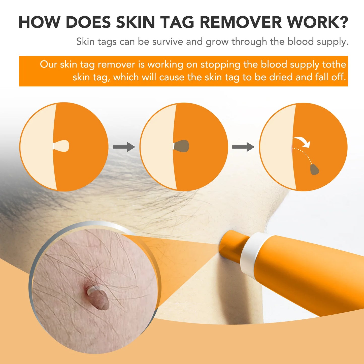Skin Tag Relief Kit™